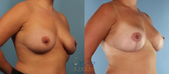 Before & After Revision Breast Surgery Case 439 Right Oblique View in Vancouver, BC