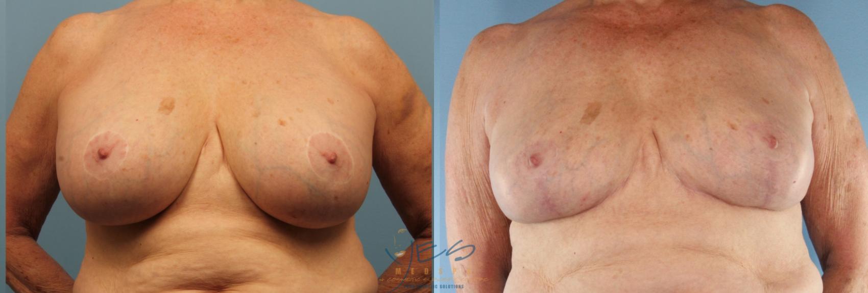 Before & After Revision Breast Surgery Case 441 Front View in Vancouver, BC