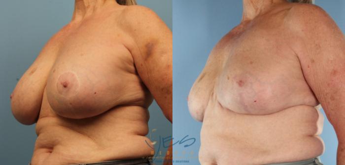 Before & After Revision Breast Surgery Case 441 Left Oblique View in Vancouver, BC