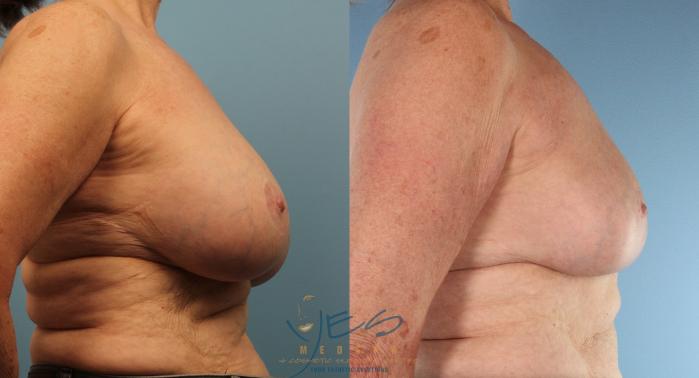 Before & After Revision Breast Surgery Case 441 Right Side View in Vancouver, BC