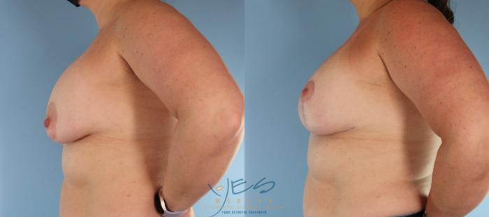 Before & After Revision Breast Surgery Case 450 Left Side View in Vancouver, BC