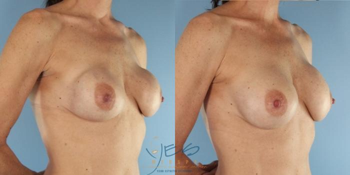 Before & After Revision Breast Surgery Case 452 Right Oblique View in Vancouver, BC