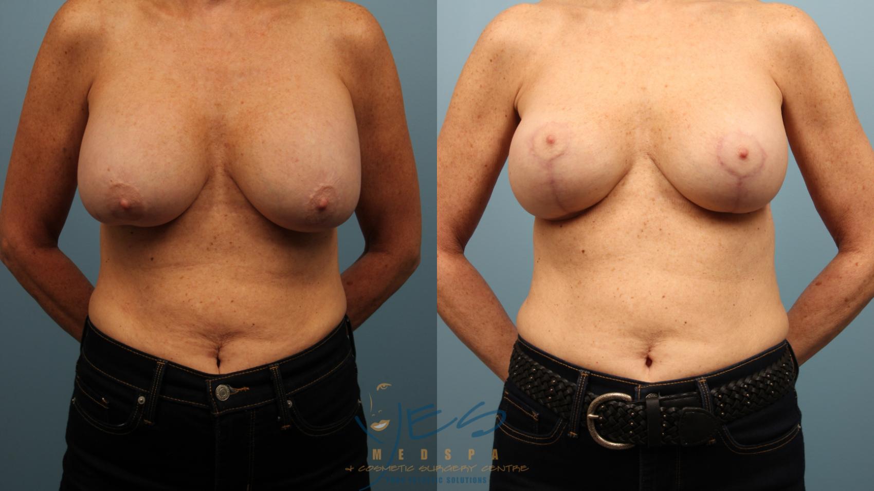 Before & After Revision Breast Surgery Case 469 Front View in Vancouver, BC