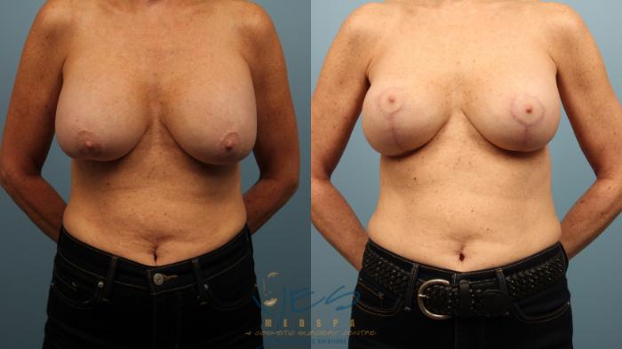 Before & After Breast Lift Case 469 Front View in Vancouver, BC