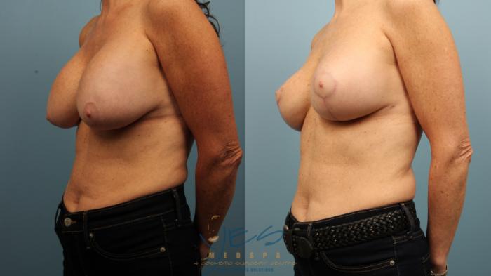 Before & After Breast Lift Case 469 Left Oblique View in Vancouver, BC