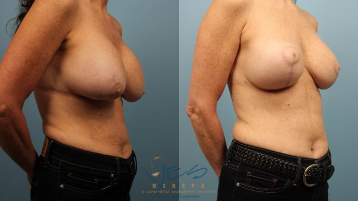 Before & After Breast Lift Case 469 Right Oblique View in Vancouver, BC