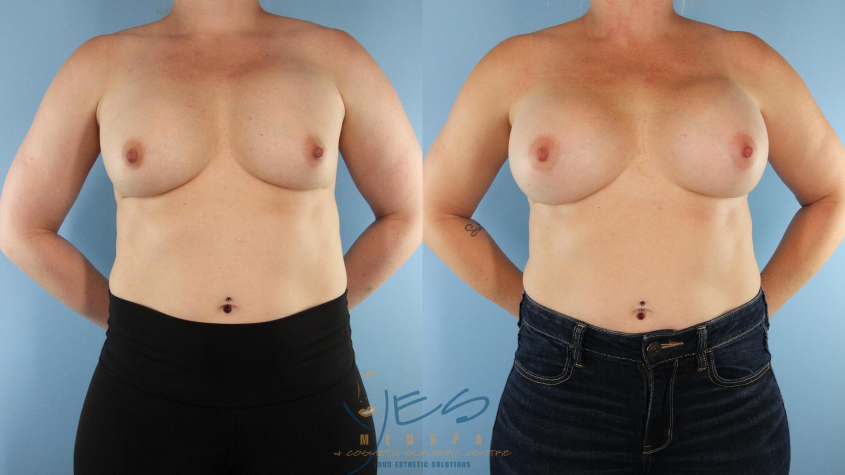 Before & After Revision Breast Surgery Case 480 Front View in Vancouver, BC
