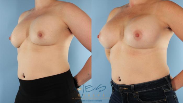Before & After Revision Breast Surgery Case 480 Left Oblique View in Vancouver, BC