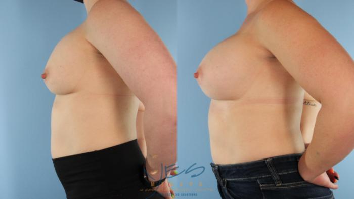 Before & After Revision Breast Surgery Case 480 Left Side View in Vancouver, BC