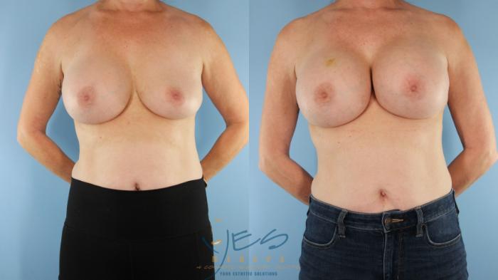 Before & After Revision Breast Surgery Case 497 Front View in Vancouver, BC