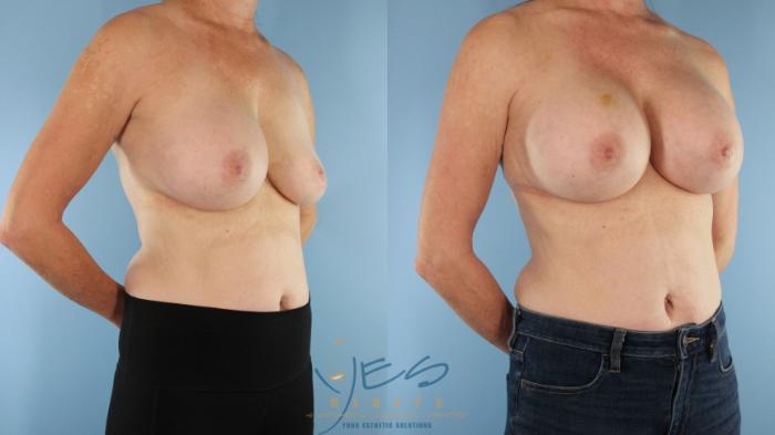 Before & After Revision Breast Surgery Case 497 Left Oblique View in Vancouver, BC