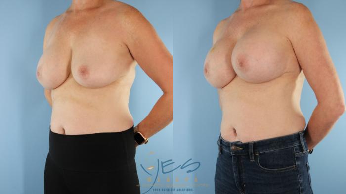 Before & After Revision Breast Surgery Case 497 Right Oblique View in Vancouver, BC