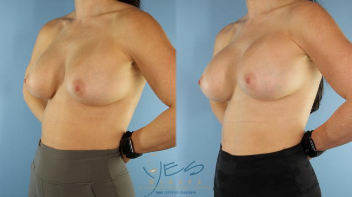 Before & After Revision Breast Surgery Case 499 Left Oblique View in Vancouver, BC