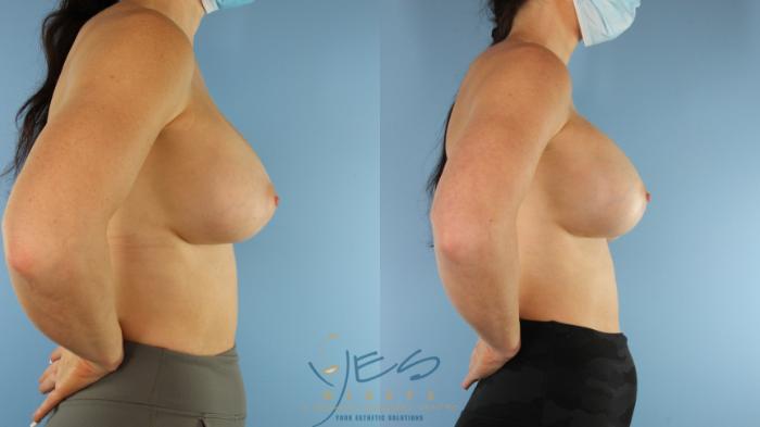 Before & After Revision Breast Surgery Case 499 Right Side View in Vancouver, BC