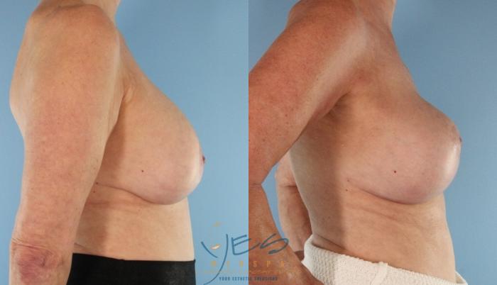 Before & After Revision Breast Surgery Case 510 Front View in Vancouver, BC