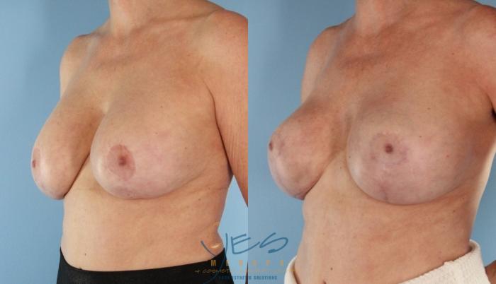 Before & After Breast Lift Case 510 Left Oblique View in Vancouver, BC