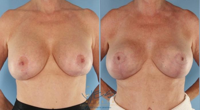 Before & After Breast Lift Case 510 Right Side View in Vancouver, BC