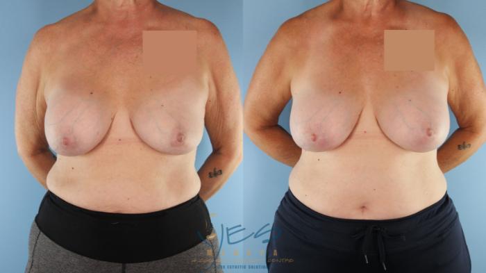 Before & After Revision Breast Surgery Case 513 Front View in Vancouver, BC