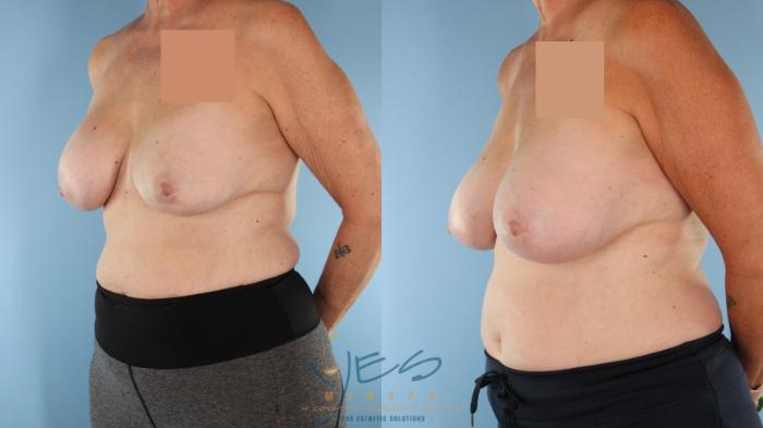 Before & After Revision Breast Surgery Case 513 Left Oblique View in Vancouver, BC