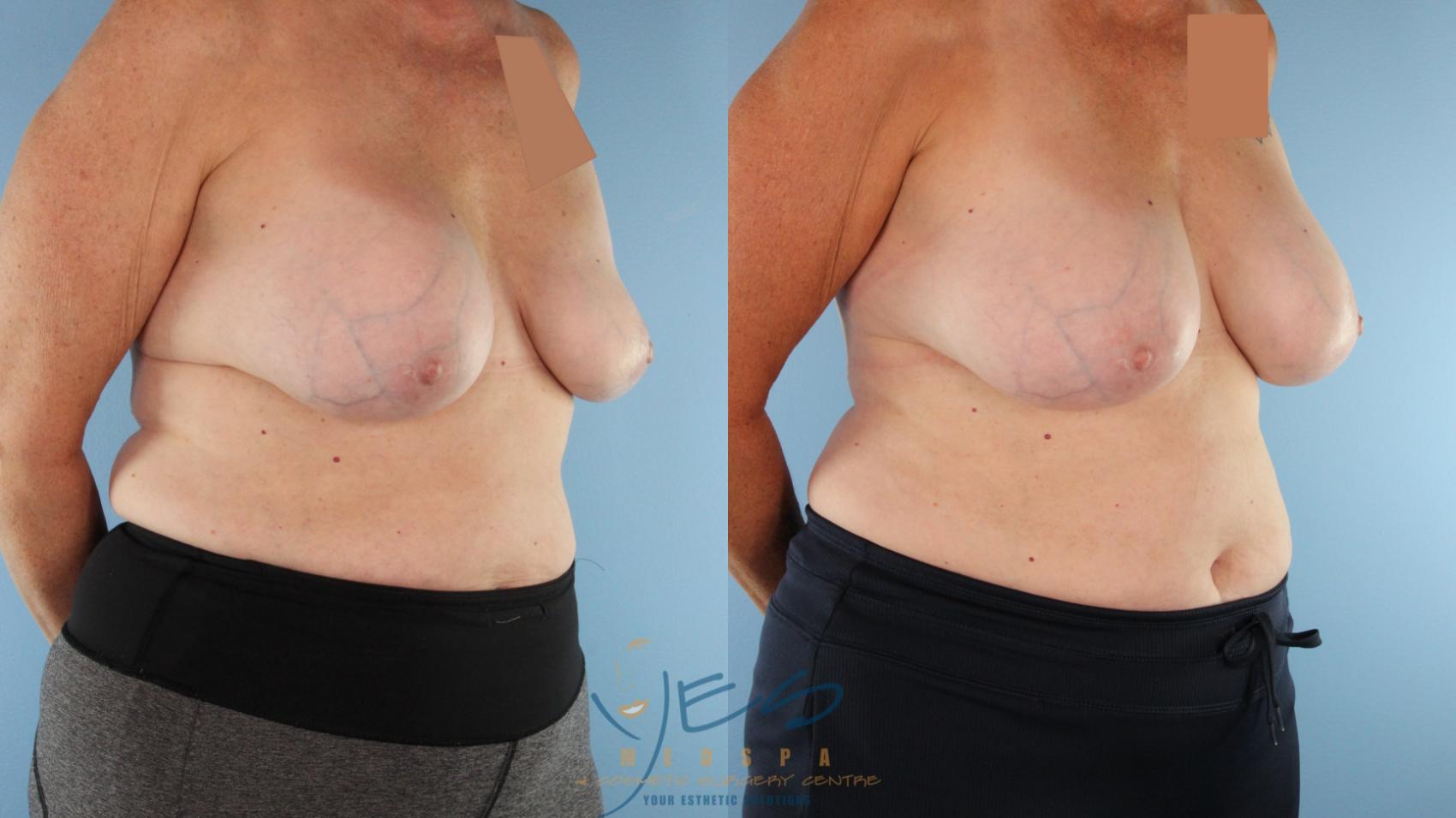 Before & After Revision Breast Surgery Case 513 Right Oblique View in Vancouver, BC