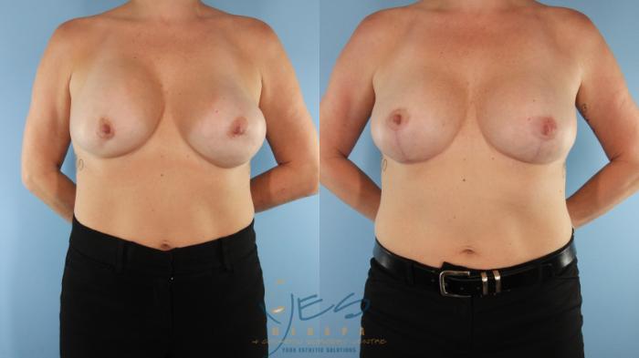 Before & After Revision Breast Surgery Case 528 Front View in Vancouver, BC