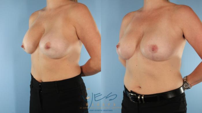 Before & After Revision Breast Surgery Case 528 Left Oblique View in Vancouver, BC