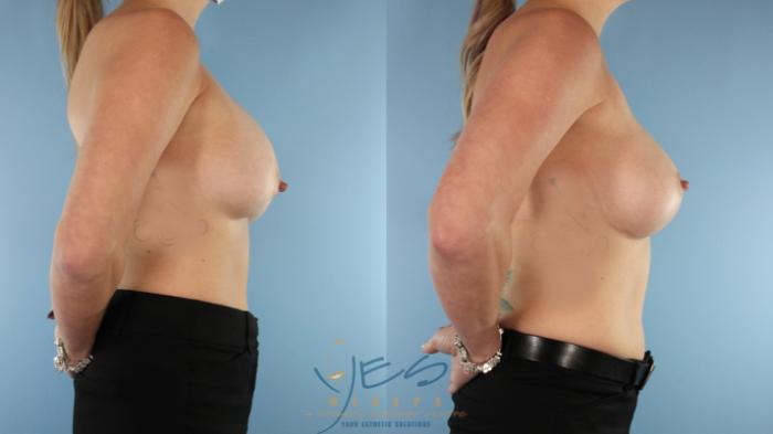 Before & After Revision Breast Surgery Case 528 Right Side View in Vancouver, BC