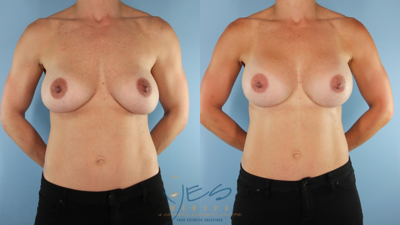 Before & After Revision Breast Surgery Case 529 Front View in Vancouver, BC