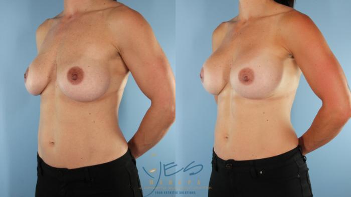 Before & After Revision Breast Surgery Case 529 Left Oblique View in Vancouver, BC