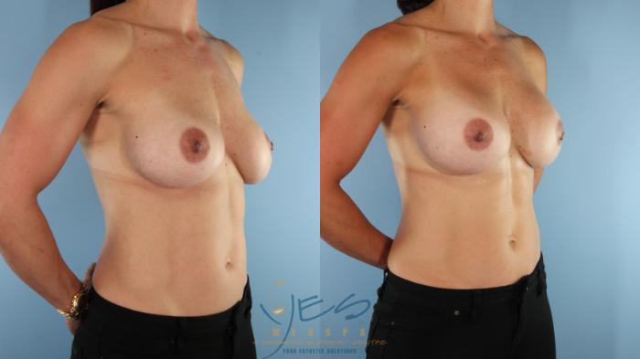 Before & After Revision Breast Surgery Case 529 Right Oblique View in Vancouver, BC