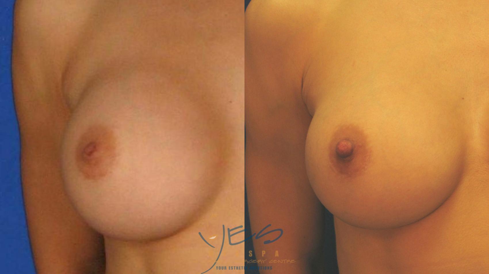 Before & After Revision Breast Surgery Case 53 Front View in Vancouver, BC
