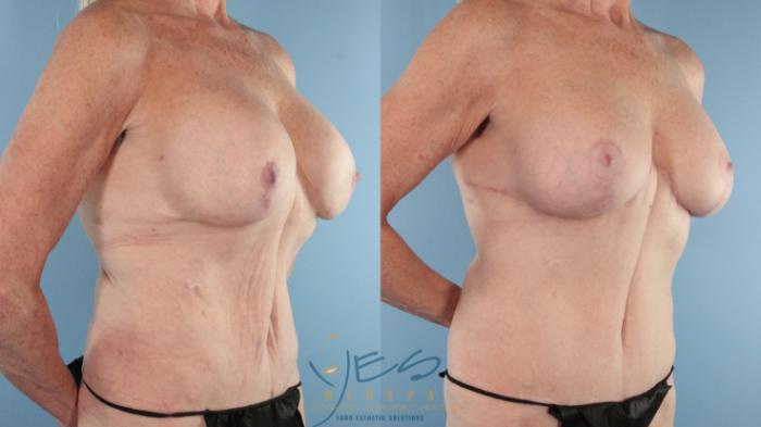 Before & After Revision Breast Surgery Case 564 Left Side View in Vancouver, BC