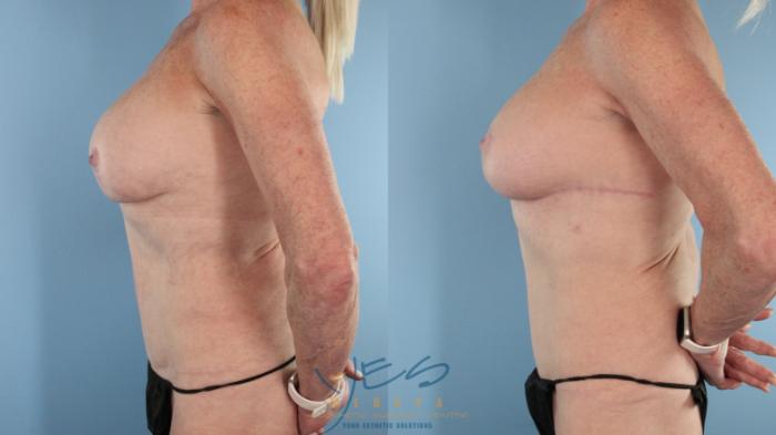 Before & After Revision Breast Surgery Case 564 Right Side View in Vancouver, BC