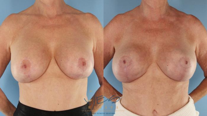 Before & After Revision Breast Surgery Case 588 Front View in Vancouver, BC