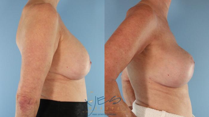 Before & After Revision Breast Surgery Case 588 Left Side View in Vancouver, BC