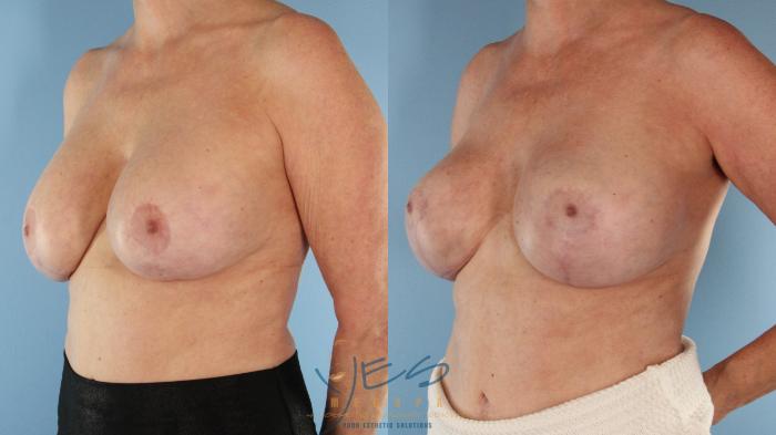 Before & After Revision Breast Surgery Case 588 Right Oblique View in Vancouver, BC