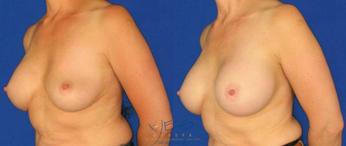 Before & After Revision Breast Surgery Case 99 View #2 View in Vancouver, BC