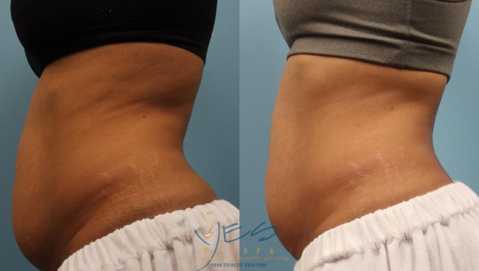 Before & After SculpSure® Case 217 View #1 View in Vancouver, BC