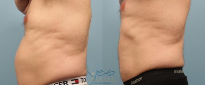 Before & After SculpSure® Case 218 View #1 View in Vancouver, BC