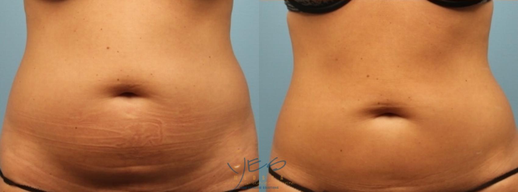 Before & After SculpSure® Case 220 View #1 View in Vancouver, BC