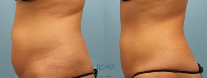 Before & After SculpSure® Case 220 View #2 View in Vancouver, BC