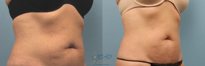 Before & After SculpSure® Case 221 Right Oblique View in Vancouver, BC