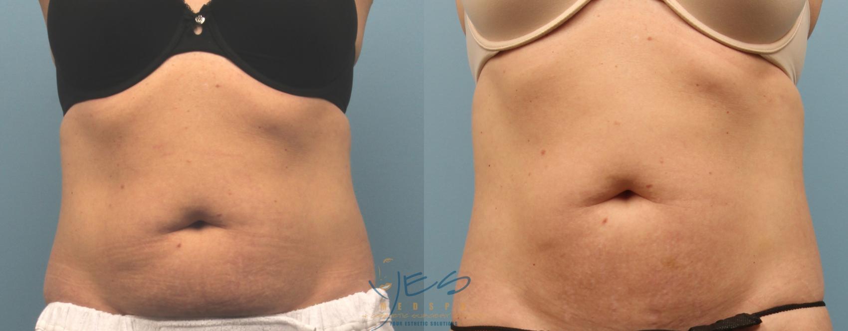 Before & After SculpSure® Case 221 View #1 View in Vancouver, BC