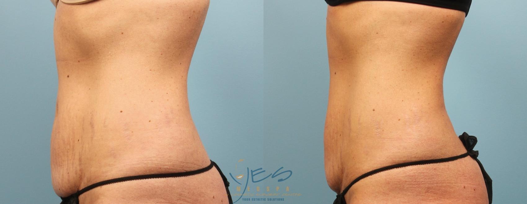 Before & After SculpSure® Case 222 View #1 View in Vancouver, BC