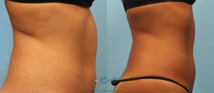 Before & After SculpSure® Case 223 Right Side View in Vancouver, BC