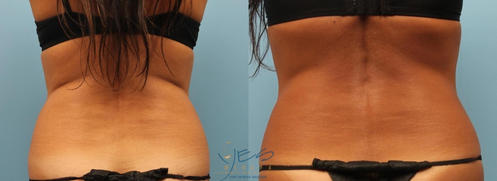 Liposuction vs. SculpSure Orange County