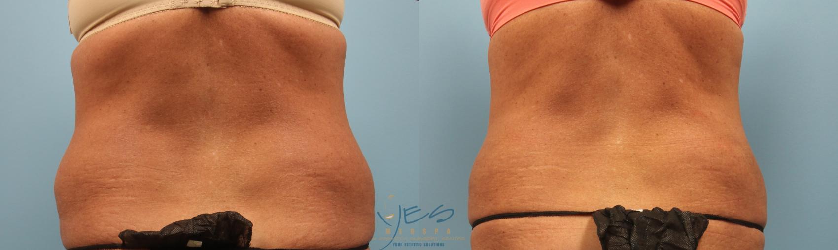Before & After SculpSure® Case 237 View #1 View in Vancouver, BC