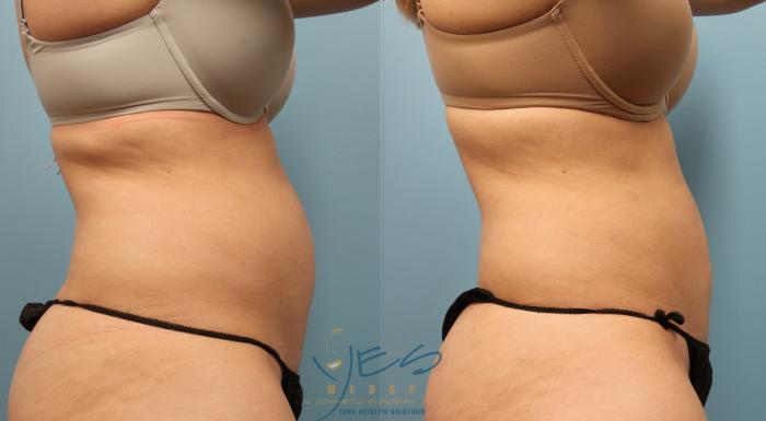 Before & After SculpSure® Case 252 View #1 View in Vancouver, BC