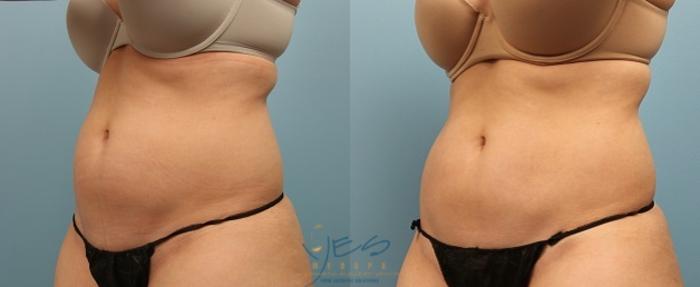 Before & After SculpSure® Case 252 View #2 View in Vancouver, BC