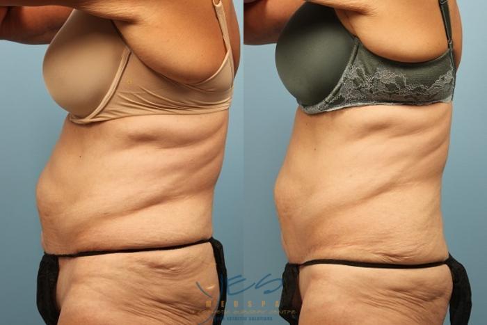 Before & After SculpSure® Case 254 View #1 View in Vancouver, BC